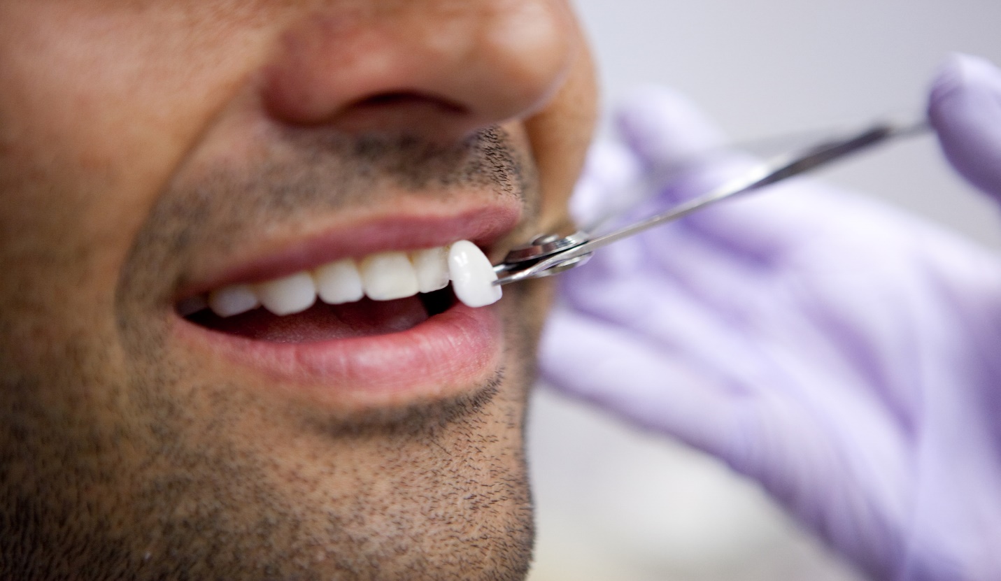 Benefits of Getting Dental Veneers & Laminates in Jacksonville, FL